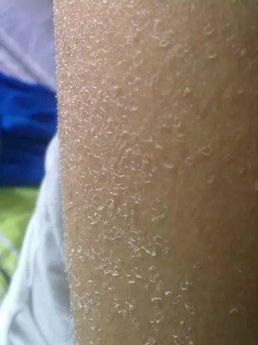 脸上干燥脱皮就算了,想着是露在外面的,但是这身上就更可怕了,脱衣似