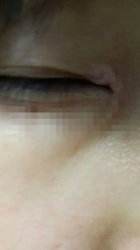 眼睛上眼皮上长了一块肉疙瘩,肤色