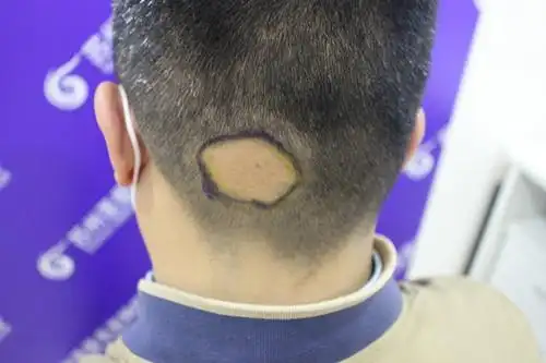 疤痕性脱发怎么治疤痕性脱发能长出来吗案例对比图