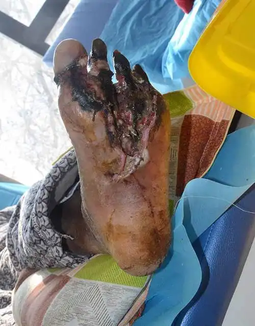 安徽患者在南京经多家医院诊断要求截肢后转入我院保守不截肢痊愈