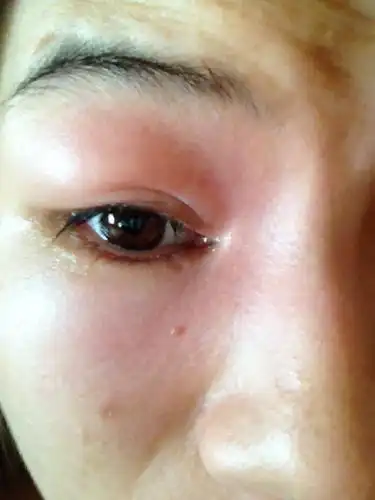 问:昨天发热吊了点滴,就右眼不舒服就用手一揉,瞬间眼睛就肿了.