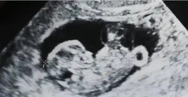 严屹宽庆生晒b超照,网友直呼又一个颜值宝宝将出生_孩子_照片_小王子