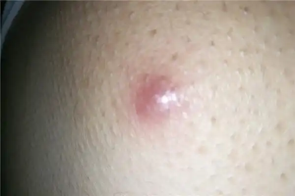 这些现象在医学中被称为毛囊炎,有很明显的特征产生于皮肤表面.