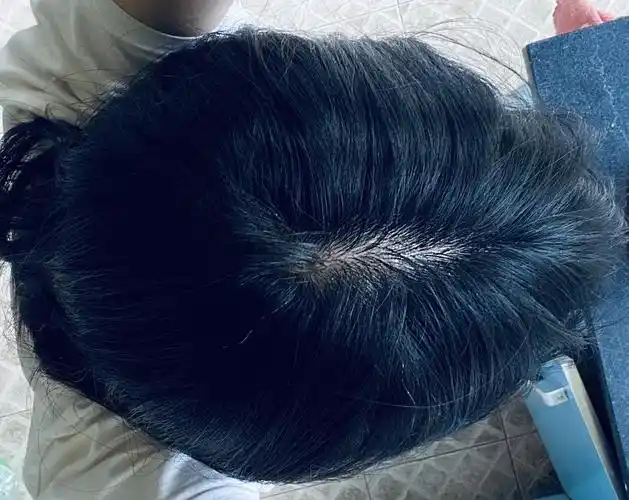 请问大家像这种头顶秃一块怎么办啊