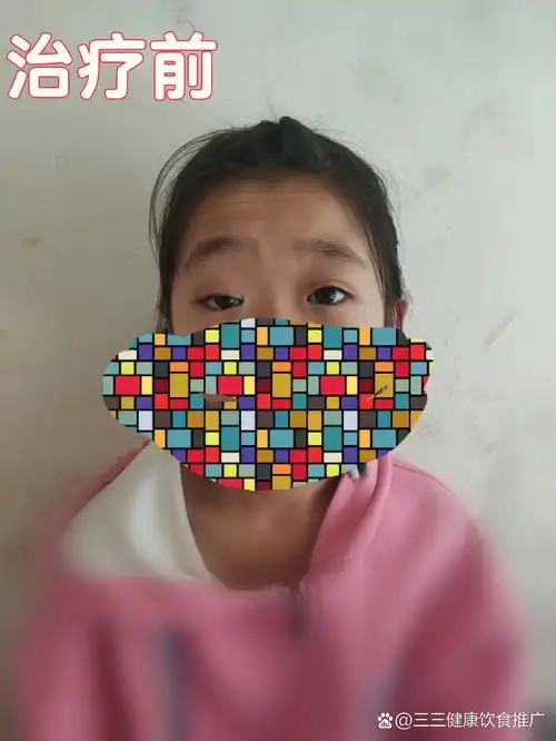 眼肌型肌无力患者治疗后明显好转