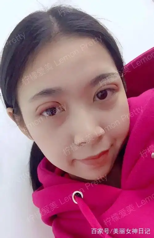 妹子做"埋线双眼皮"半个月后,同事们夸她现在挺有气质的!哈哈