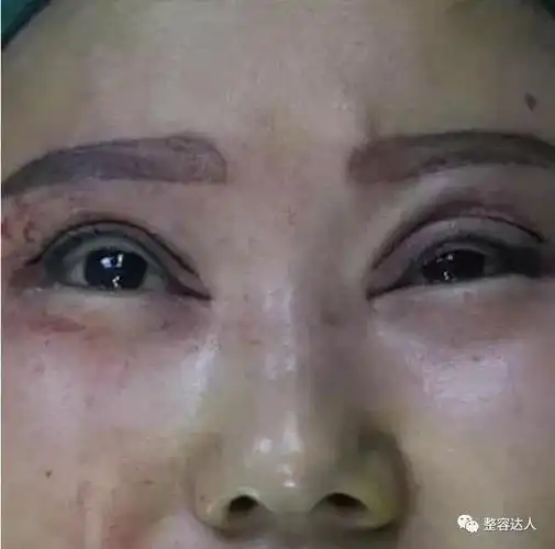 细数8种失败的双眼皮有你吗