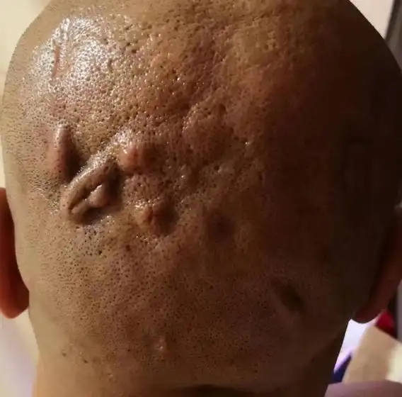 王利兰:穿掘性毛囊炎会死人吗?该怎么治疗?