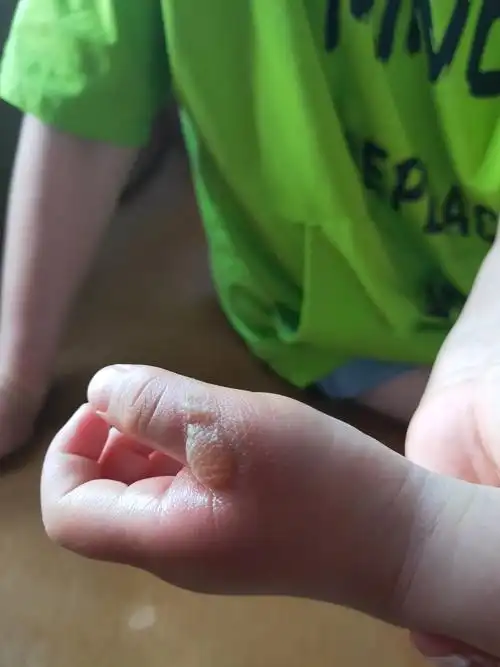 孩子在幼儿园被烫伤了