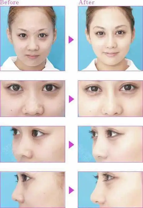 变化还是很明显的对不_圈子-新氧美容整形