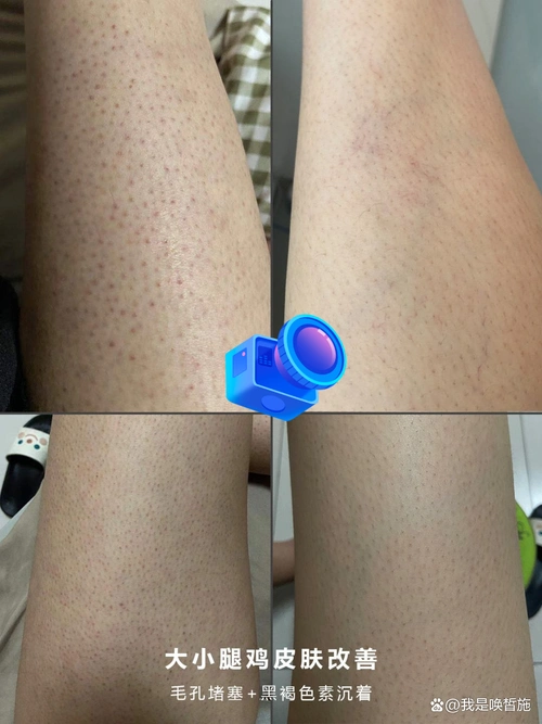 手臂有鸡皮肤能够 纹身吗