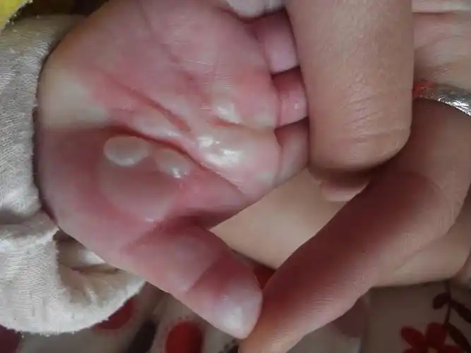 宝宝烫伤要去医院吗?