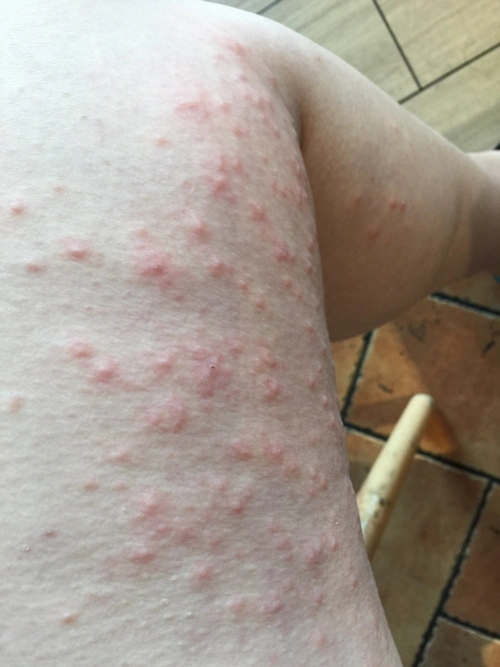 去医院看了,说是妊娠痒疹!宝妈有什么好办法吗?实在痒的受不了