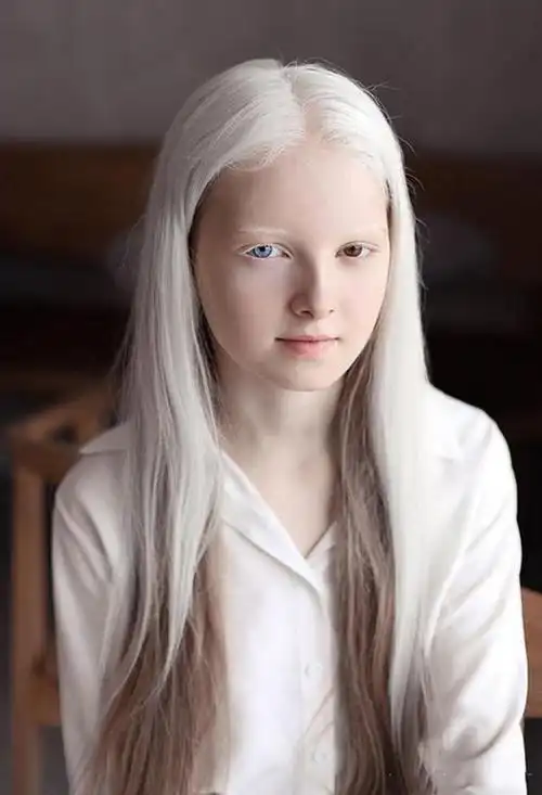 白化病,其实是一种广泛存在自然界中的一种遗传疾病,包括人来在内的