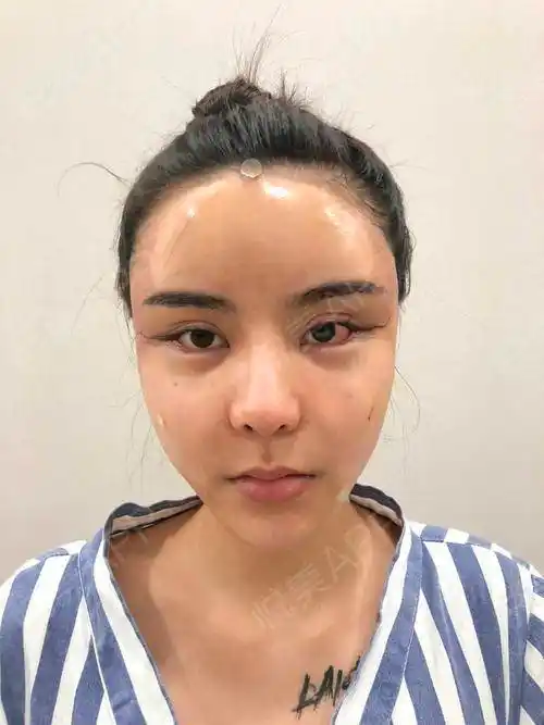 自体脂肪面部填充术后1天_假体垫眉弓术后1天_面部填充术后1天_隆眉弓