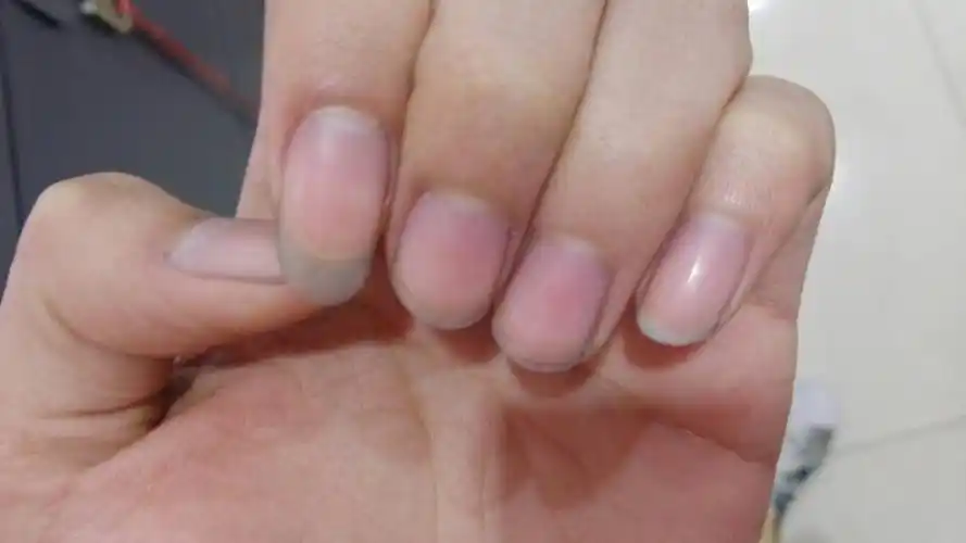 指甲发紫黑