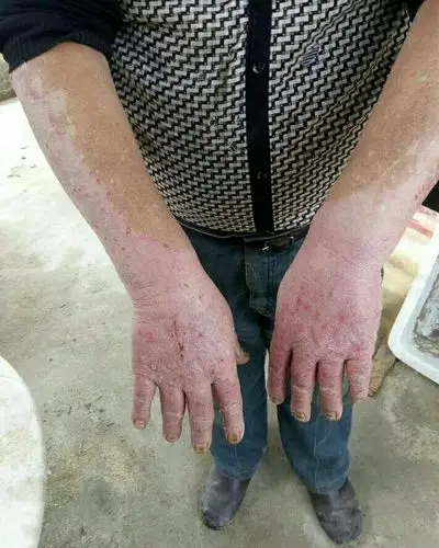 严重的皮肤病吃华蒜豆40多天的效果