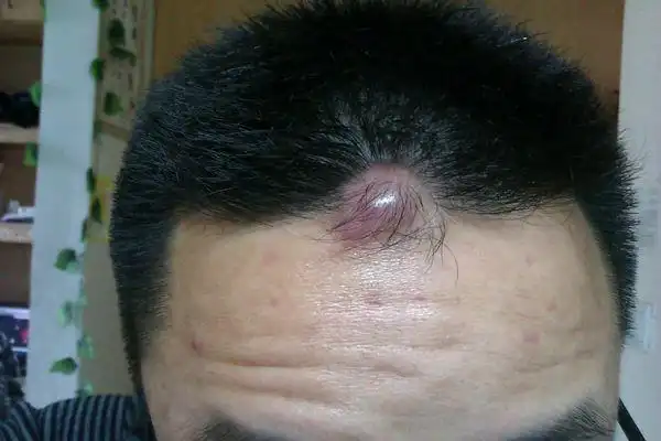 您好,医生,我去医院医生诊断为毛囊腺囊肿