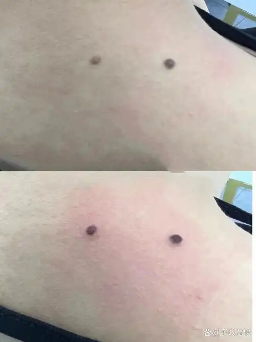 "男后女颈 肩上 上背长痣,无形中有"一座大山"直一压着你,会影响自身