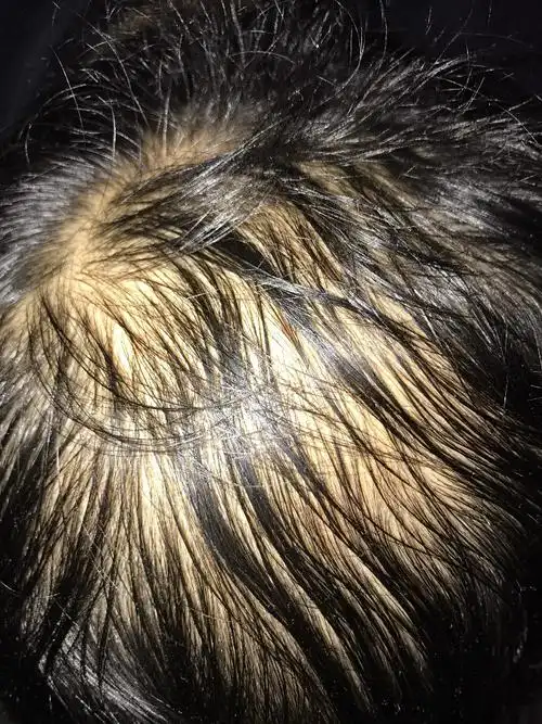 本人男41岁,头发最早也是两个鬓角少,近三年头顶有点谢顶.