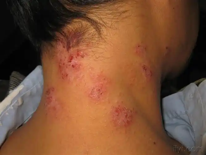 看图识病-----神经性皮炎 - 皮肤及性传播疾病讨论版 - 爱爱医医学