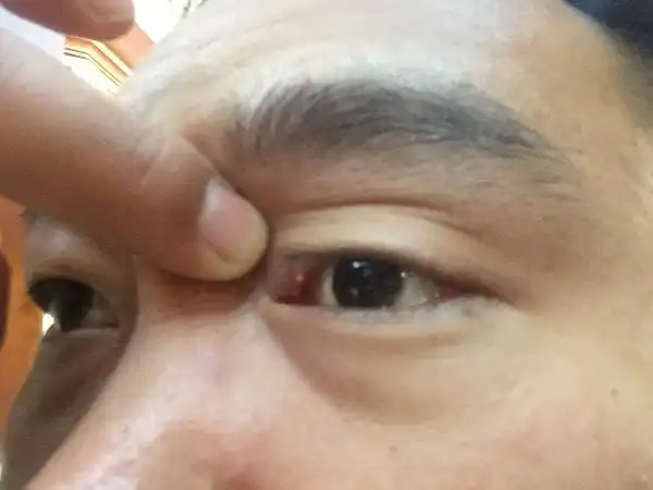 眼皮里起了个白色颗粒点是什么东西?