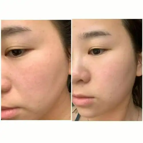 同样是用美白祛斑霜五天的对比