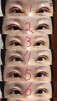 上海百达丽邵玉芳医生割双眼皮开内眼角 提肌术后效果照