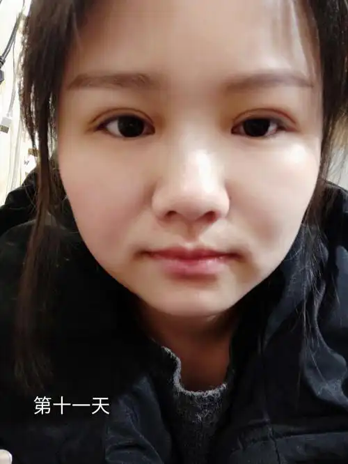 埋线双眼皮感觉失败