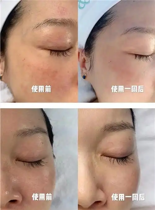 品牌新闻 品牌新闻 正文使用对比图   使用前:皮肤晒伤大面积变红.