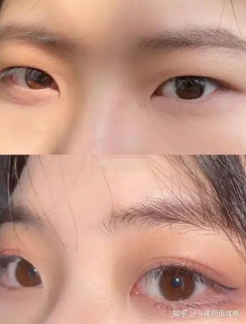 合肥做双眼皮一般需要多少钱啊?