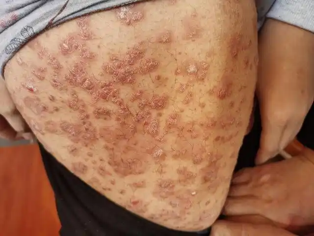 牛皮藓的早期图片