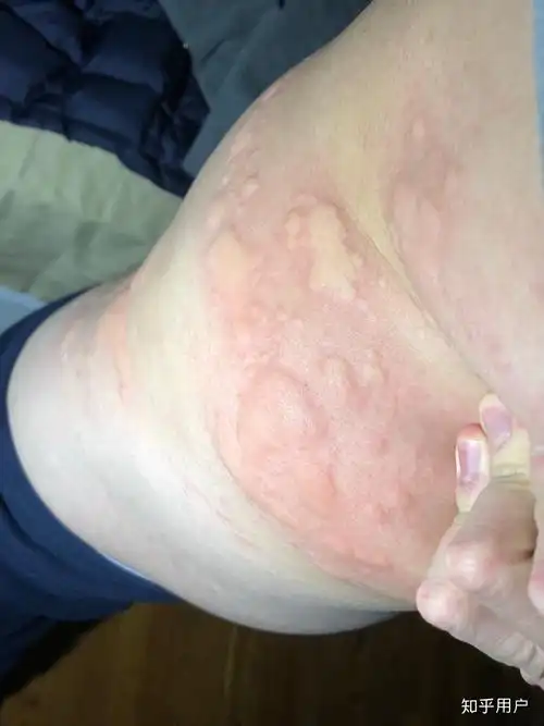 有没有小伙伴和我一样的荨麻疹症状,上图? - 知乎