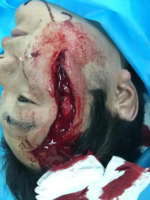 面部切割伤-医联