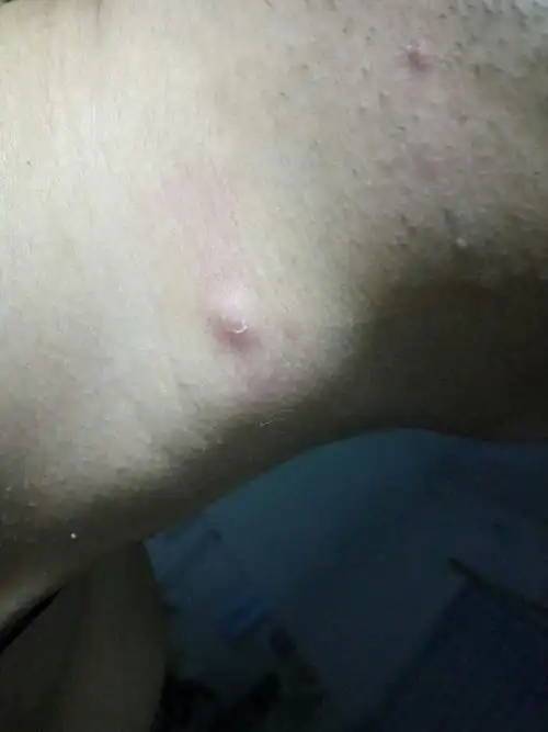 脖子上出了个疙瘩硬硬的,快一星期了,不痒也不疼,不知是啥情况