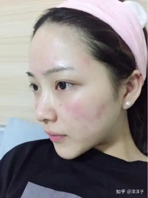 如何增厚脸部皮肤的角质层有什么吹爆的增厚脸部角质层的办法