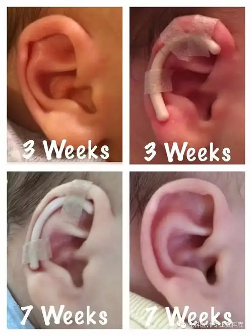 孩子耳廓被折住了,是怎么回事?