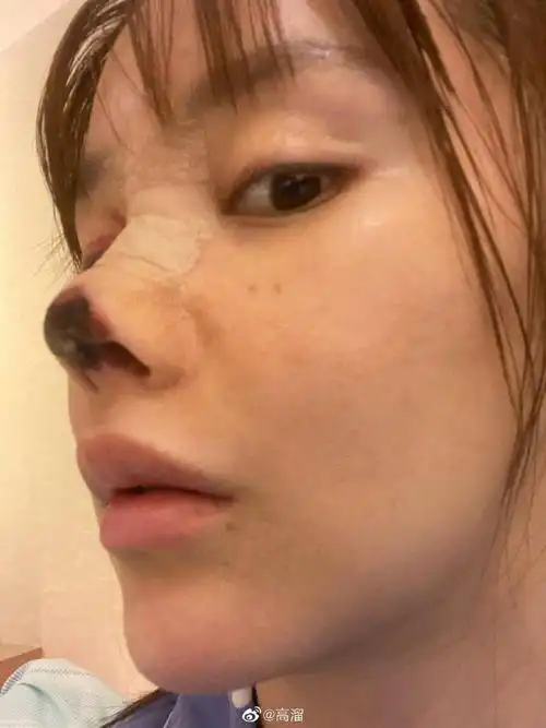 女星整容失败鼻子坏死医院不管朋友介绍我去的还打了5折