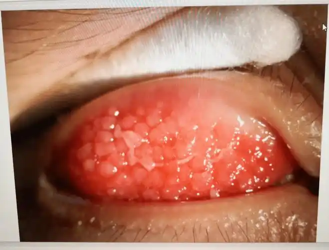 12岁小孩翻开眼皮,竟然密密麻麻都是这个东西._小江_视力_检查