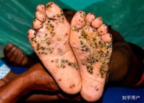 有哪些逼死密集恐惧症的图片或视频? - 知乎