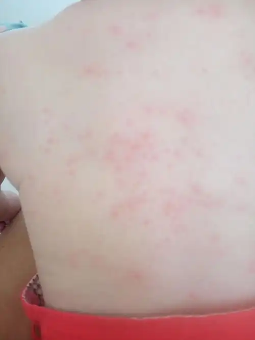 116天的宝宝后背起了很多红豆豆是什么情况?