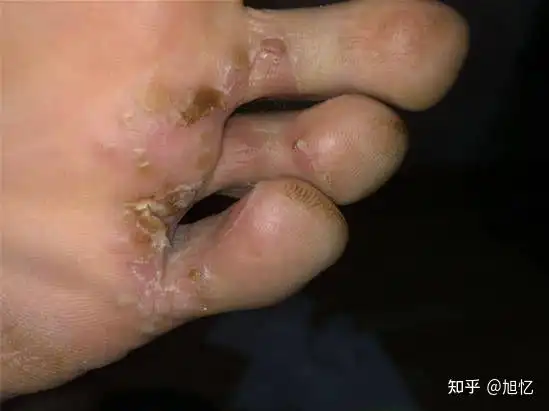 女生有脚气的多吗?你是怎么去除脚气的?