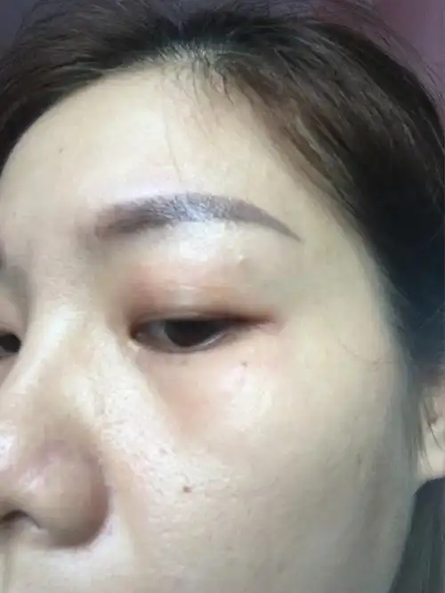 擦过红霉素眼膏,敷补水面膜