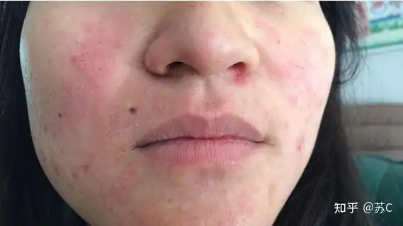 揭秘什么是皮肤屏障皮肤屏障受损的原因是什么出现皮肤屏障你第一时间