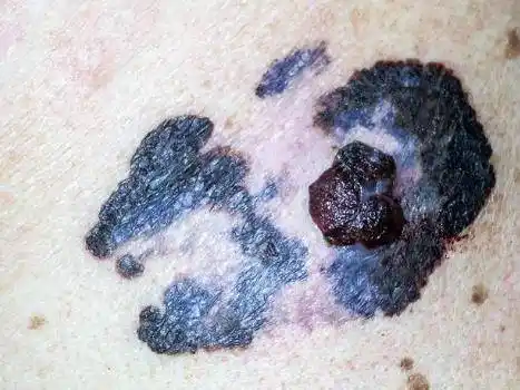 一些慢性刺激和炎症也会导致皮肤病,如慢性溃疡,盘状红斑狼疮,放射性