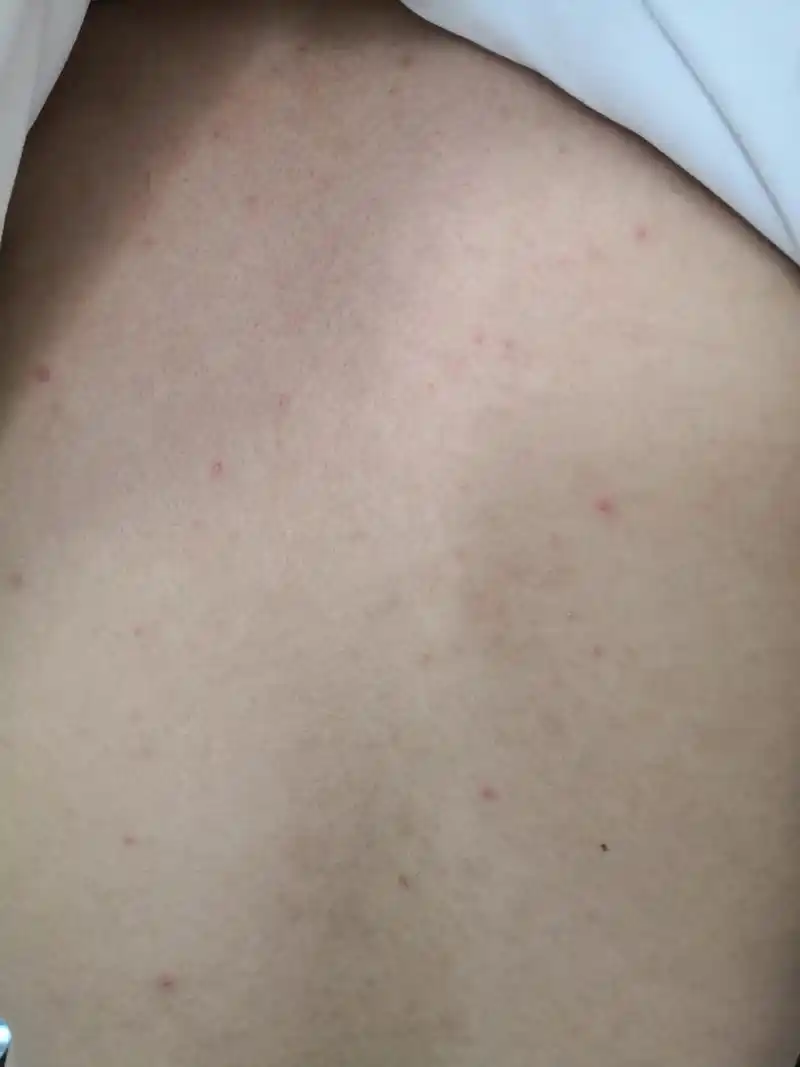 背部毛囊炎症状#解决皮肤问题专注皮肤美容