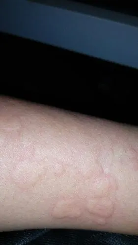 全身痒,挠了就起红疙瘩,疙瘩略有点扁,差不多从凌晨3点开始,是过敏吗?