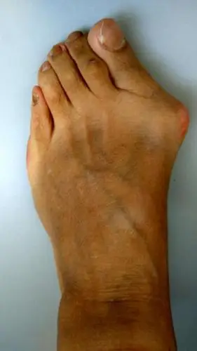 拇外翻患者手术前后对比 - 好大夫在线