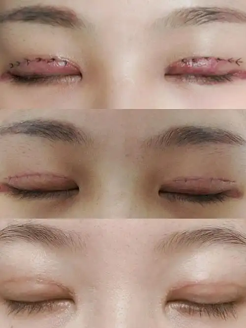 全切平扇75mm谁见谁夸的妈生双眼皮