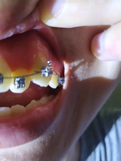 如图,这是一颗高位虎牙.